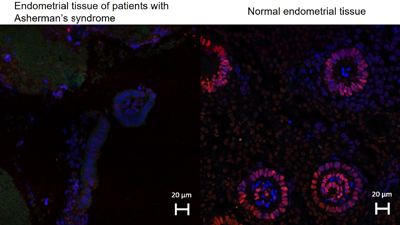 Endometrial biopsy sections; thin (left) and healthy endometrium (right), were subjected to immunofluorescence labeling.