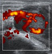 Doppler ultrasound image with corpus luteum showing high vascularization, a positive predictive diagnosis.